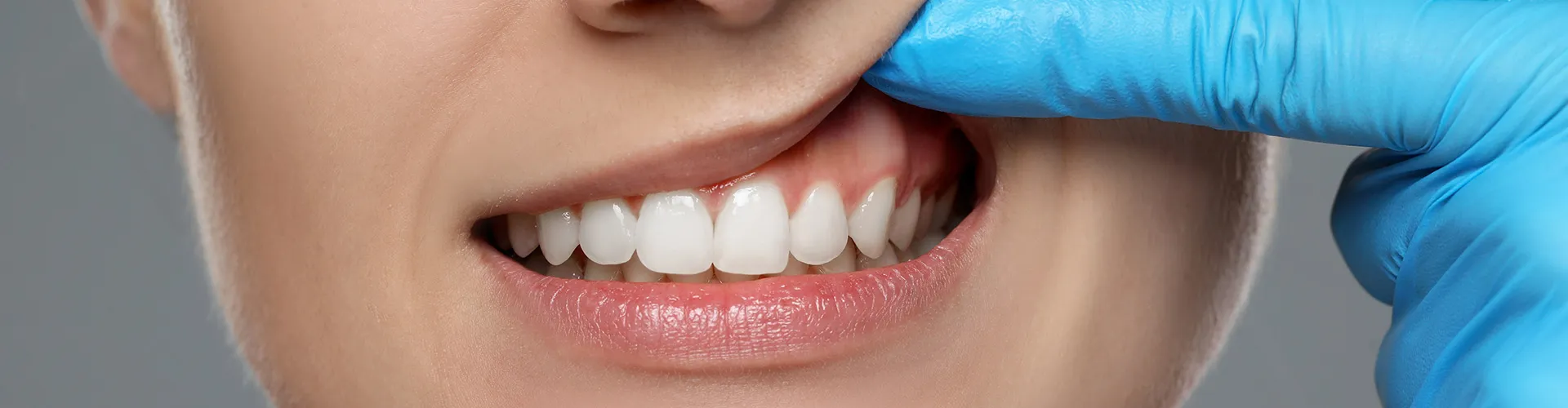 Close-up of a woman showing her teeth, with a blue-gloved finger lifting her upper lip to reveal her gums.