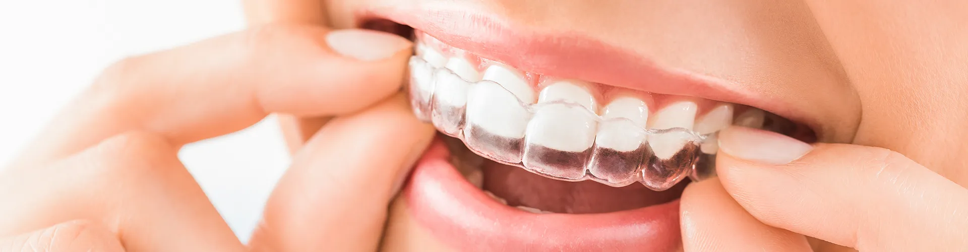 Woman putting clear aligner in mouth.