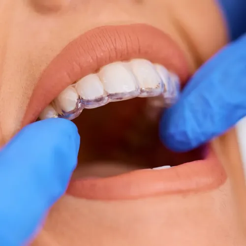 Close-up of a patient wearing a clear orthodontic aligner while a dental professional in blue gloves examines the fit.
