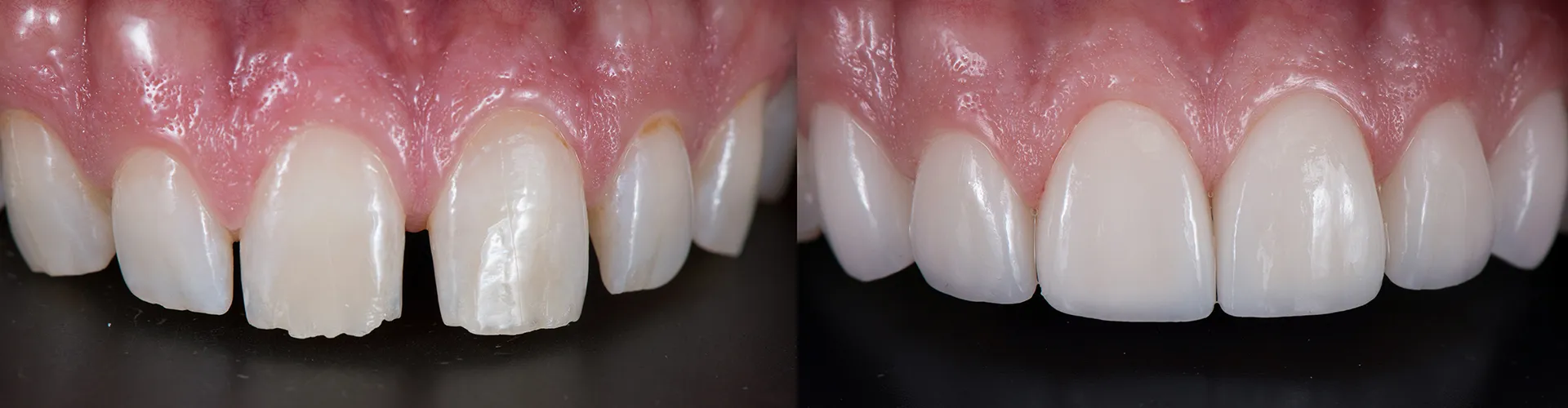Before-and-after comparison of teeth without and with veneers.
