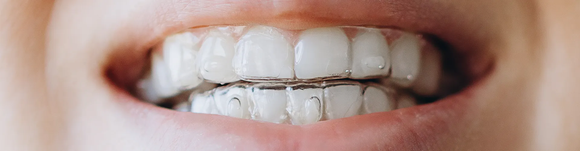 Close up of smile wearing clear retainers.