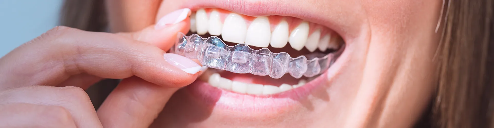 A woman inserting her clear aligners.