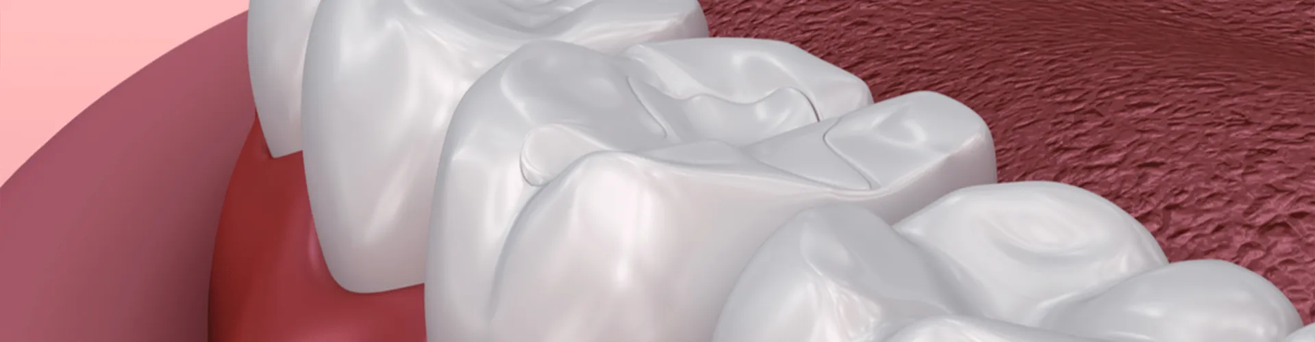 Rendering of a cavity filling in a tooth.