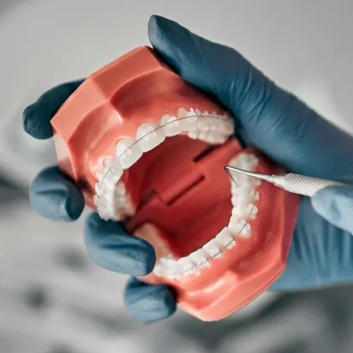 Ceramic dental braces on a dental model being examined with a dental instrument.