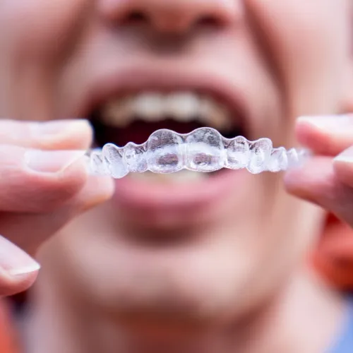 Close-up of a woman smiling while holding a clear orthodontic aligner near her teeth.