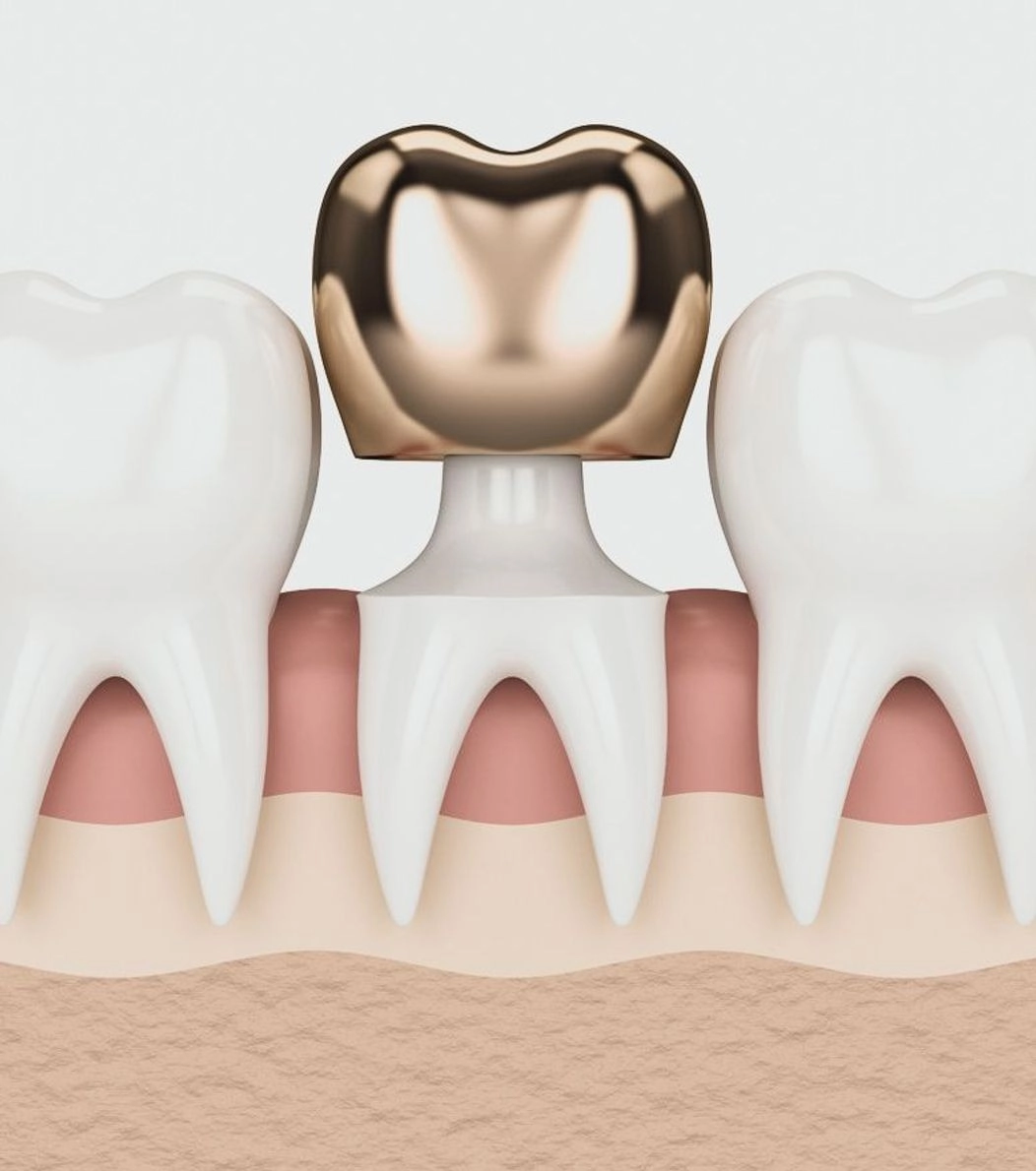 An image of a gold crown being placed on a tooth