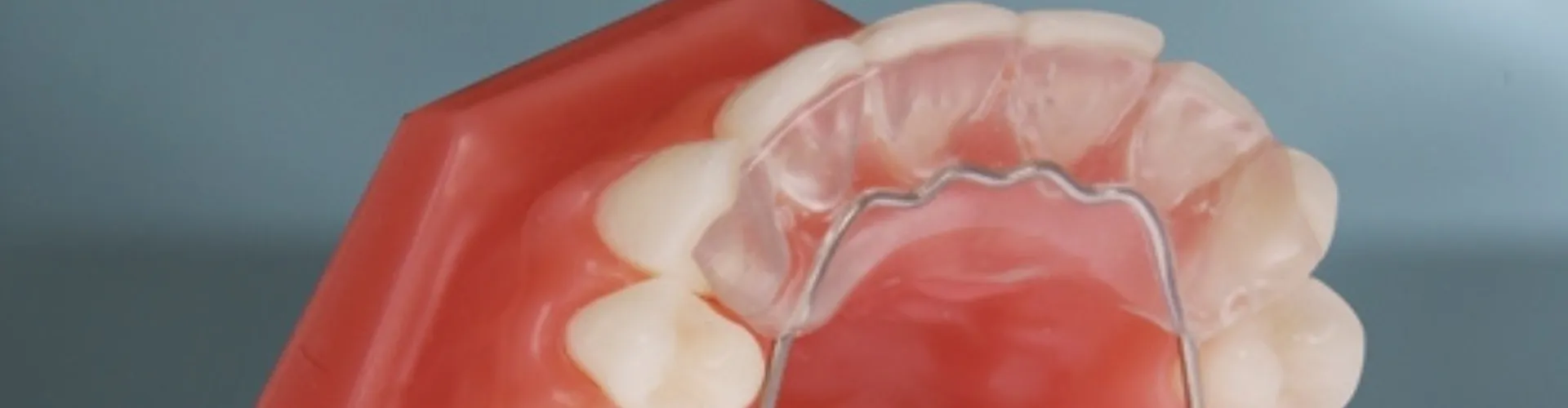 Mouth model with a bite plate behind the upper teeth.