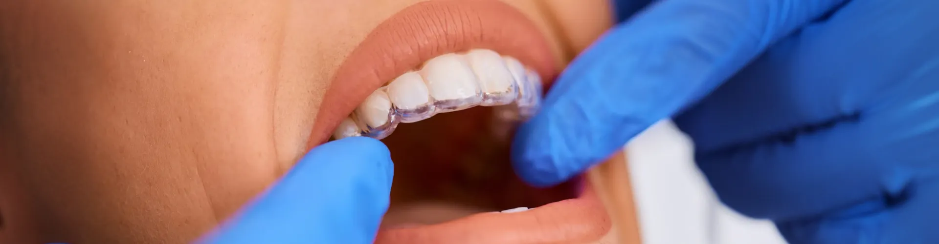Close-up of a patient wearing a clear orthodontic aligner while a dental professional in blue gloves examines the fit.