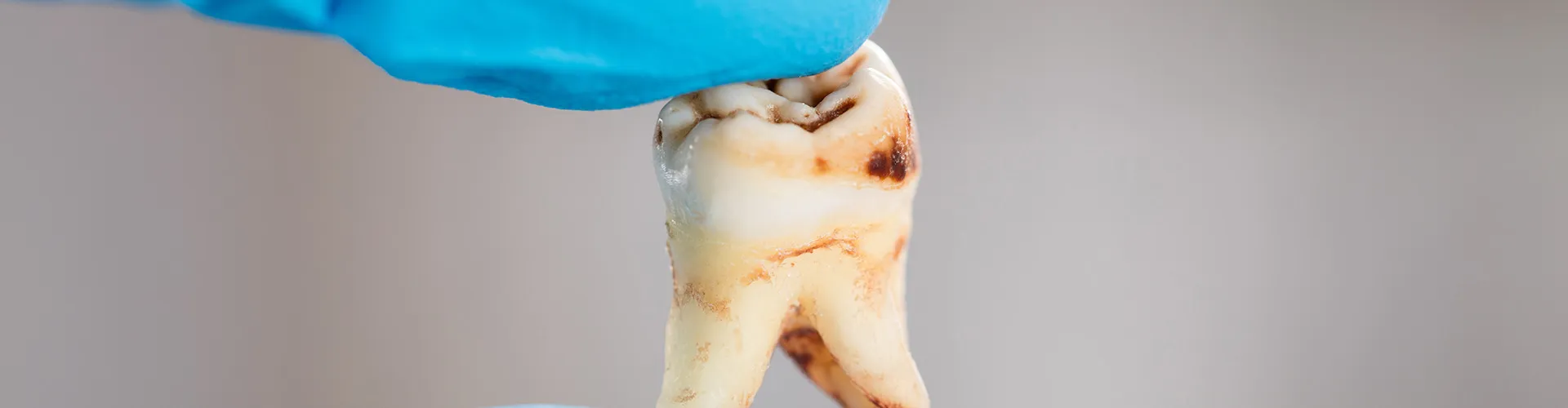 Gloved fingers holding an extracted decayed tooth.
