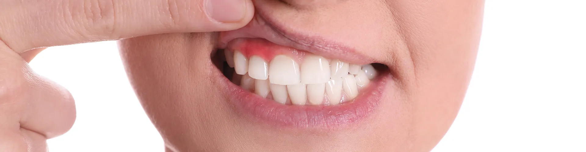 Woman lifting upper lip to show inflamed gum.