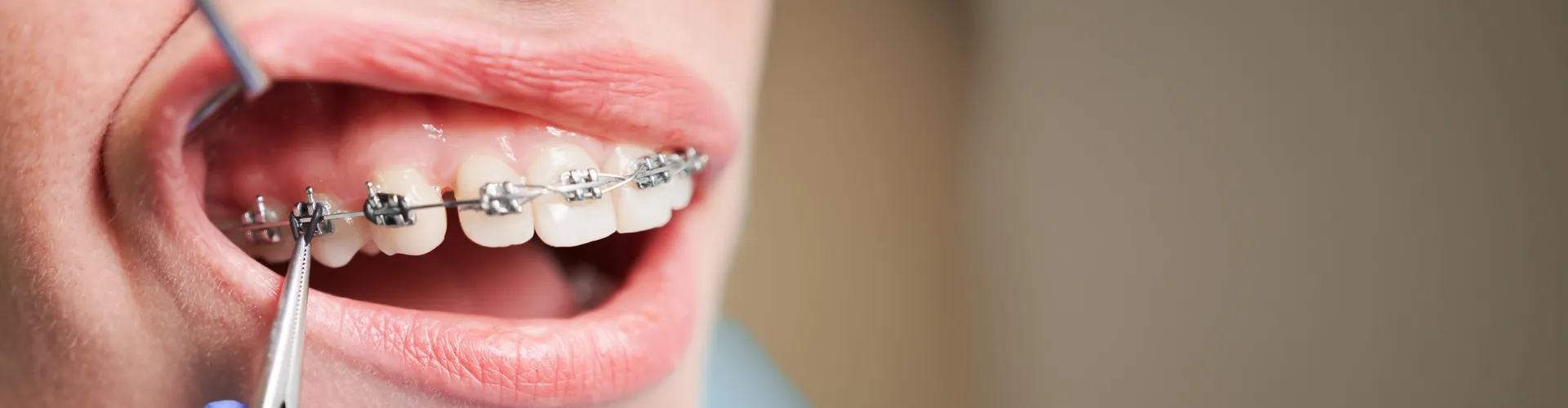 Orthodontist using dental tools to adjust metal braces on a patient's teeth.