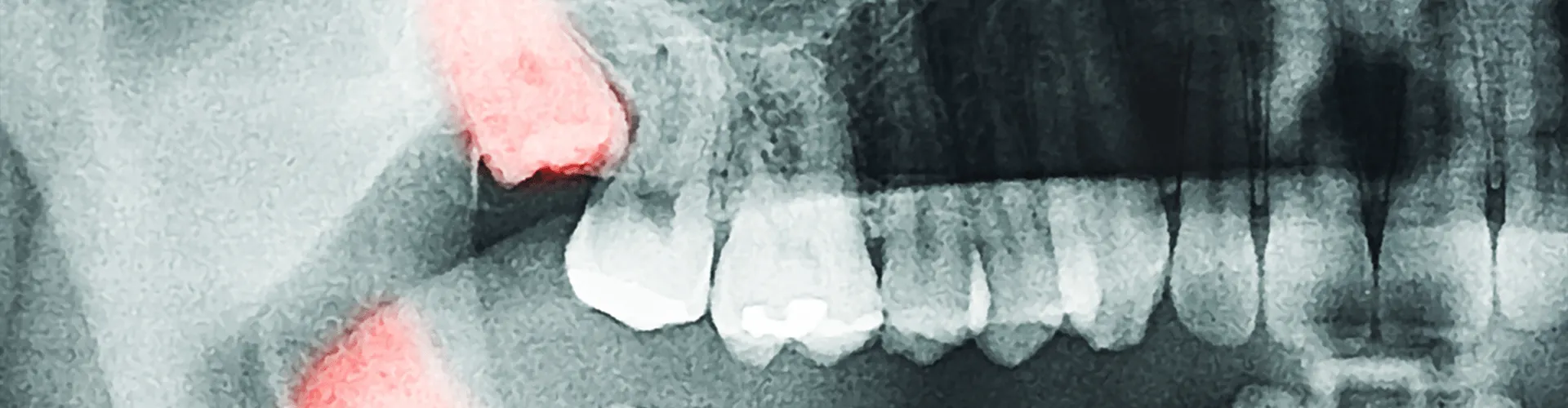 X-ray of impacted wisdom teeth.