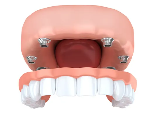 3D render of dental all on 4