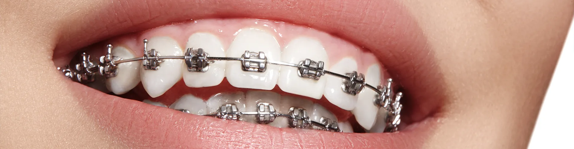 Woman's smile with dental braces.