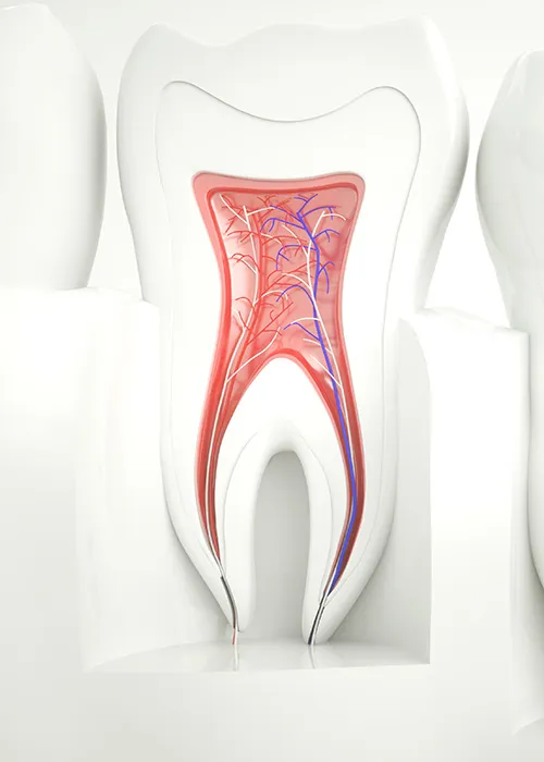 Dental root canal illustration