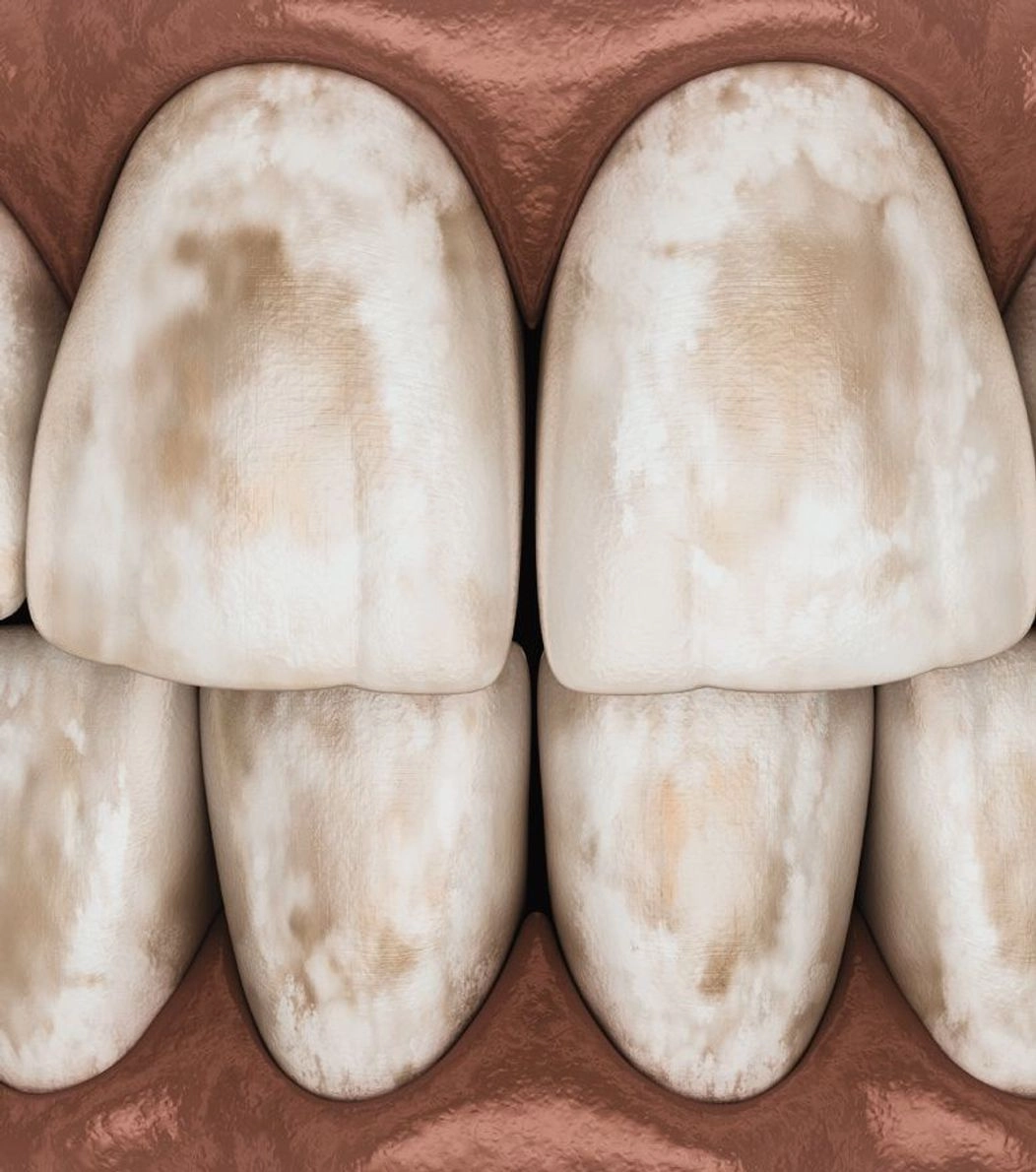 An image of discolored teeth