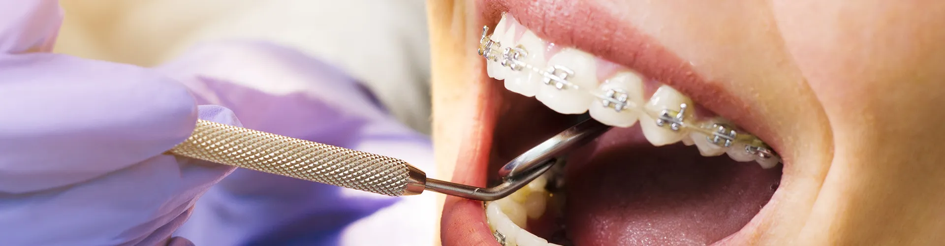 A smile with braces surrounded by dental tools.