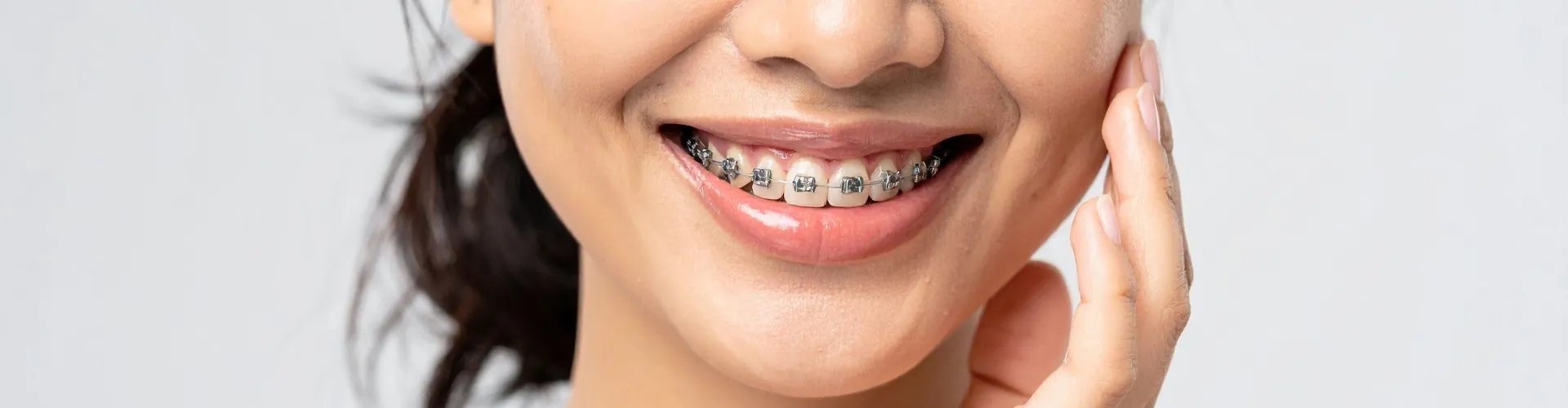 woman's smile with metal braces-main.png (https://dl.airtable.com/.directUploadAttachment/9142c8a768aedb76d314116e7b9b784d/44ab47cf/womanssmilewithmetalbraces-main.png)