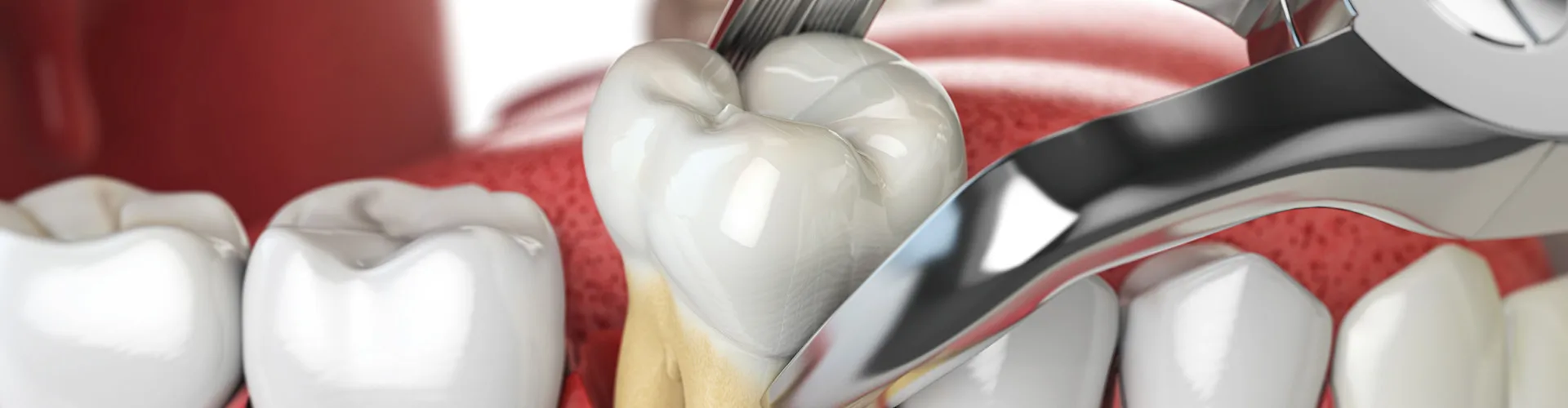 3D rendering of a tooth being extracted.