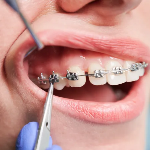 Orthodontist using dental tools to adjust metal braces on a patient's teeth.