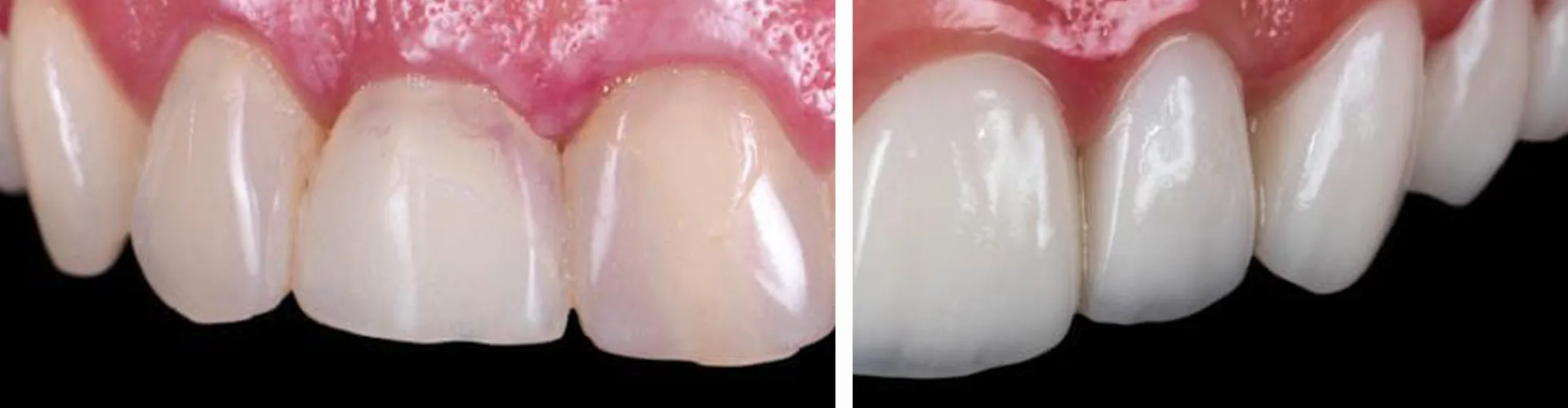 Before and after of teeth that have undergone contouring.