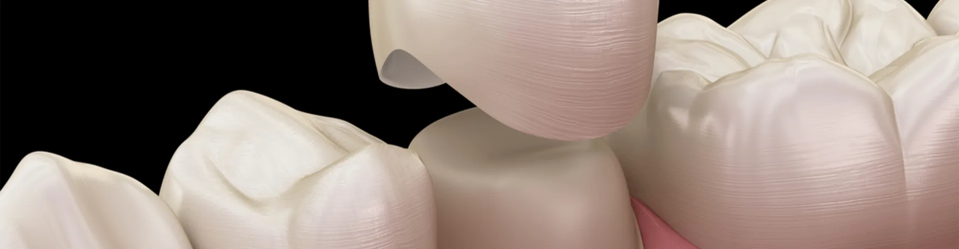 Rendering of a porcelain tooth crown.