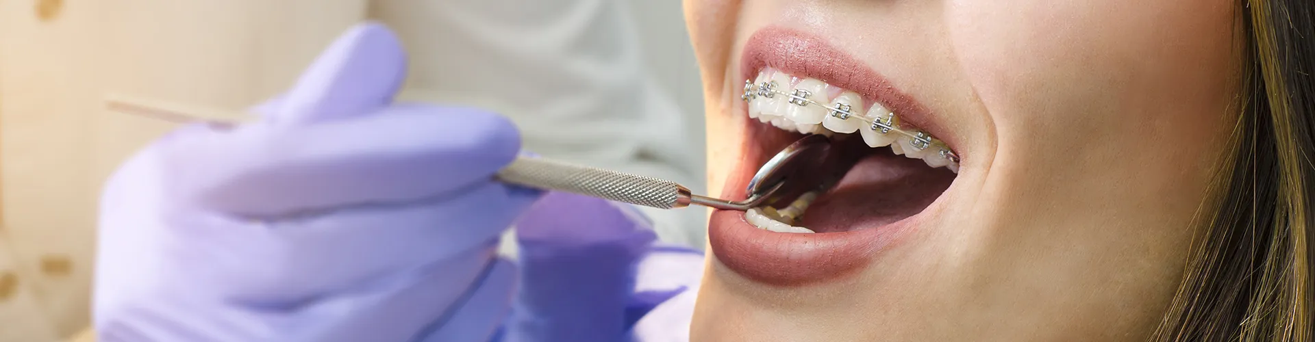 Gloved hands holding dental mirror in woman's mouth with braces.
