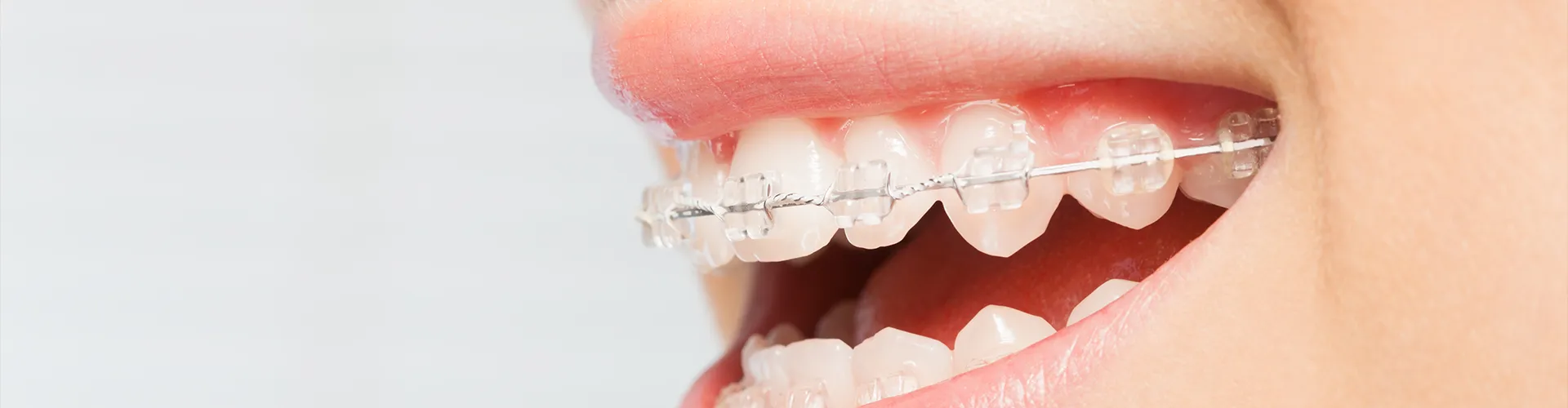 Smiling girl wearing dental braces.