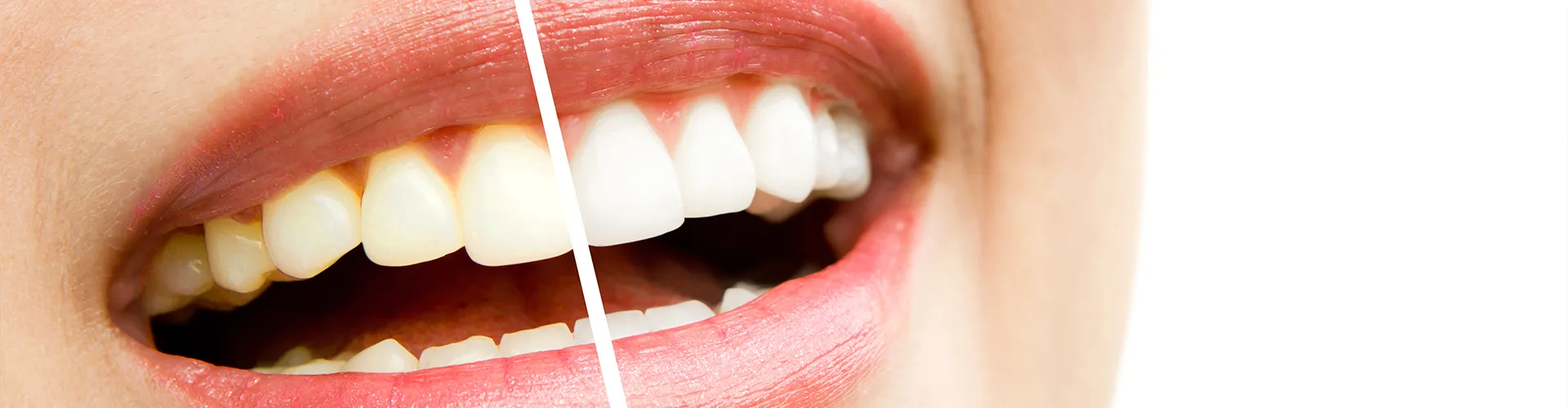 Image of woman with half teeth yellow and half white.