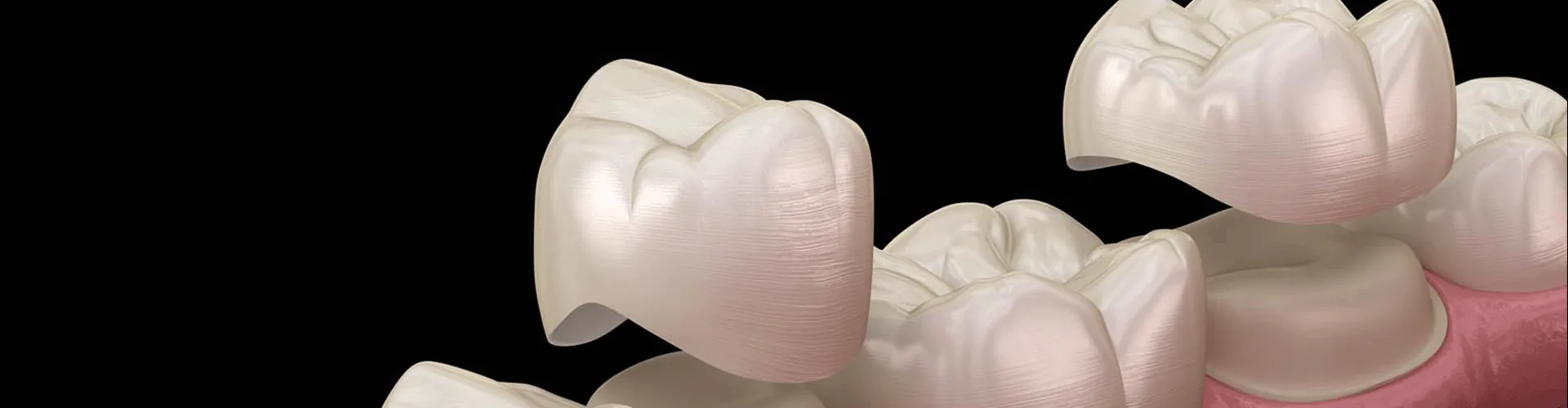 Rendering of two dental crowns being placed on lower teeth.