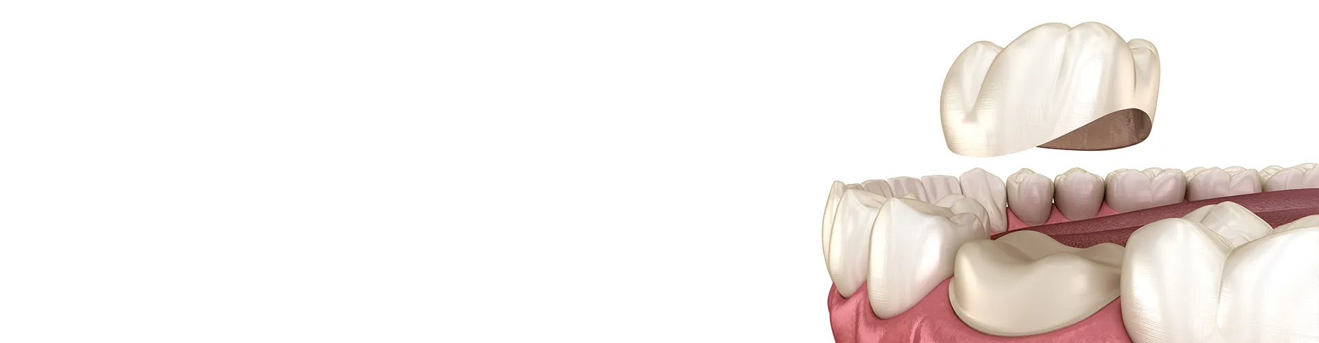 Rendering of a lower jaw with a crown going on a tooth.