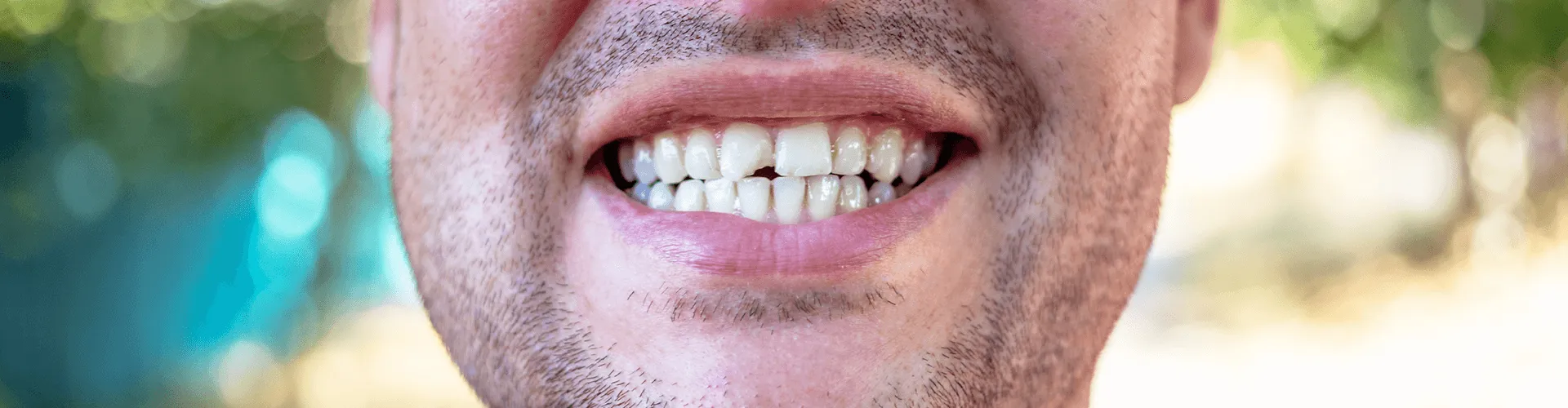 Male smiling with chipped front tooth.