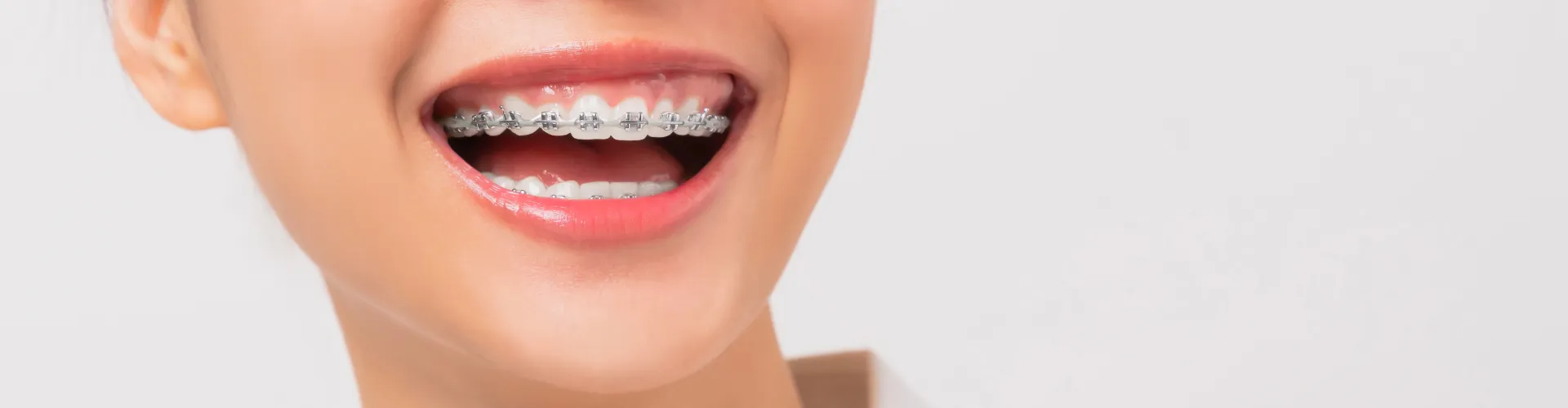 Smiling woman with braces.