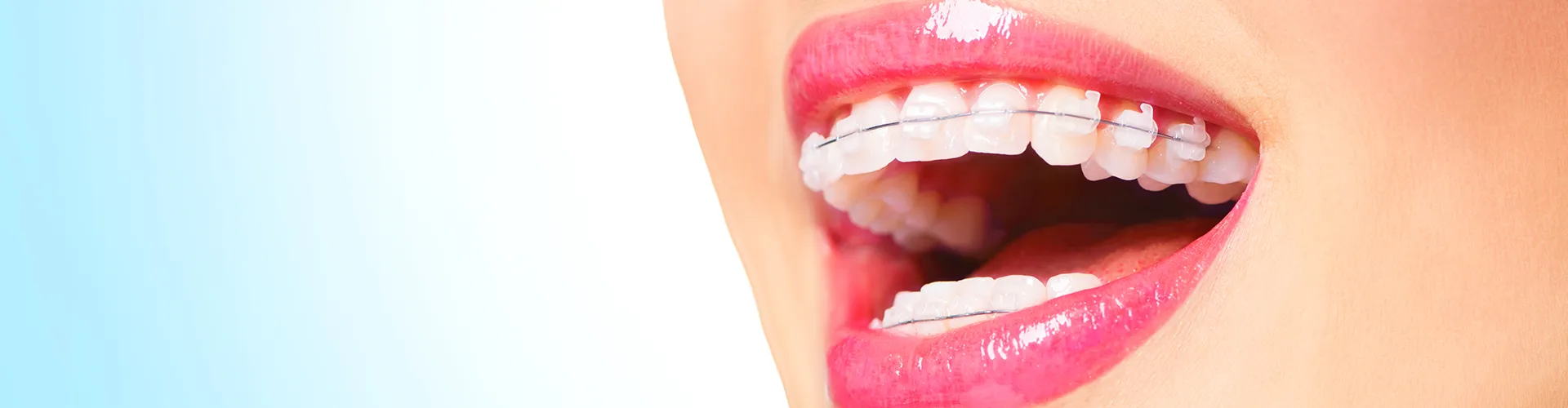Close up of a woman's smile with braces.