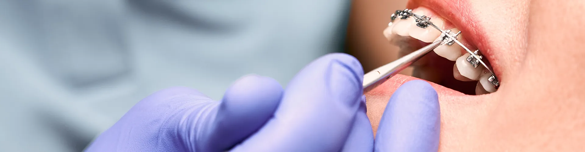 Close-up of purple-gloved hands working on a smile with braces.