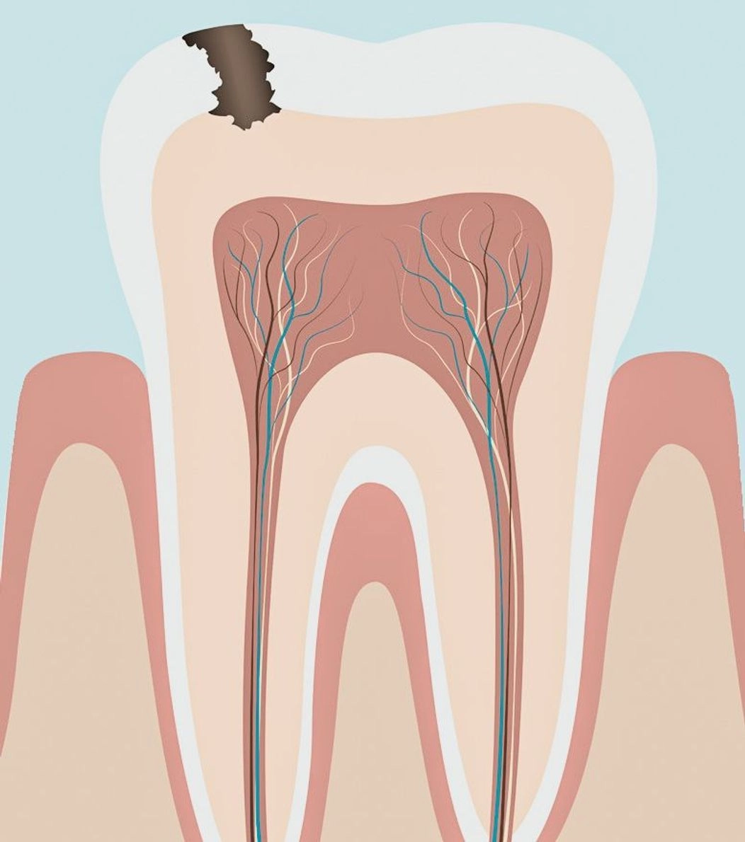 An image of the anatomy of a tooth showing progressing dental decay