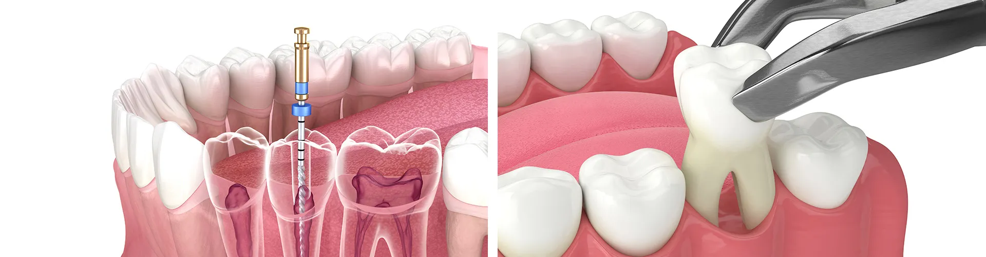 Renderings of a tooth receiving a root canal and a tooth being extracted.
