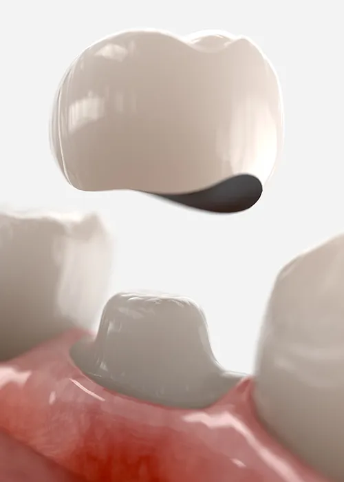 3d render dental crown