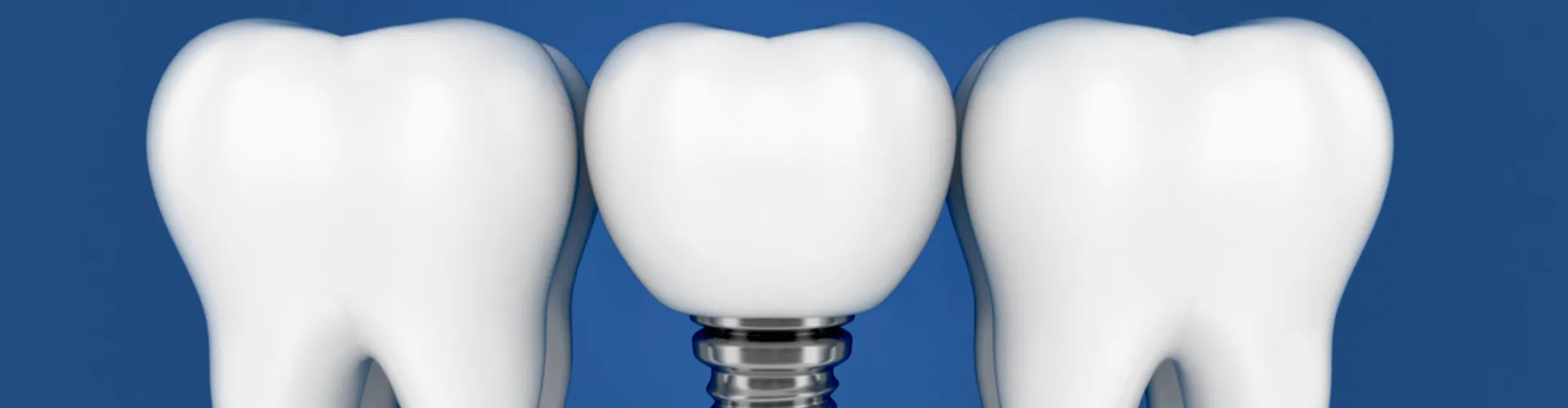 Rendering of a dental implant between teeth.