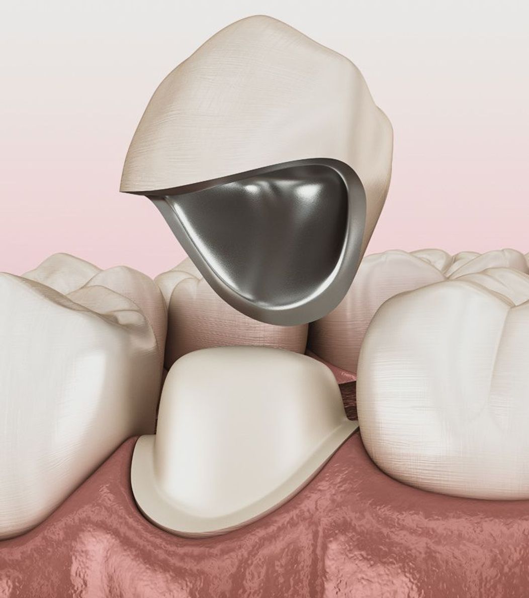 An image of a PMF dental crown being placed on a tooth