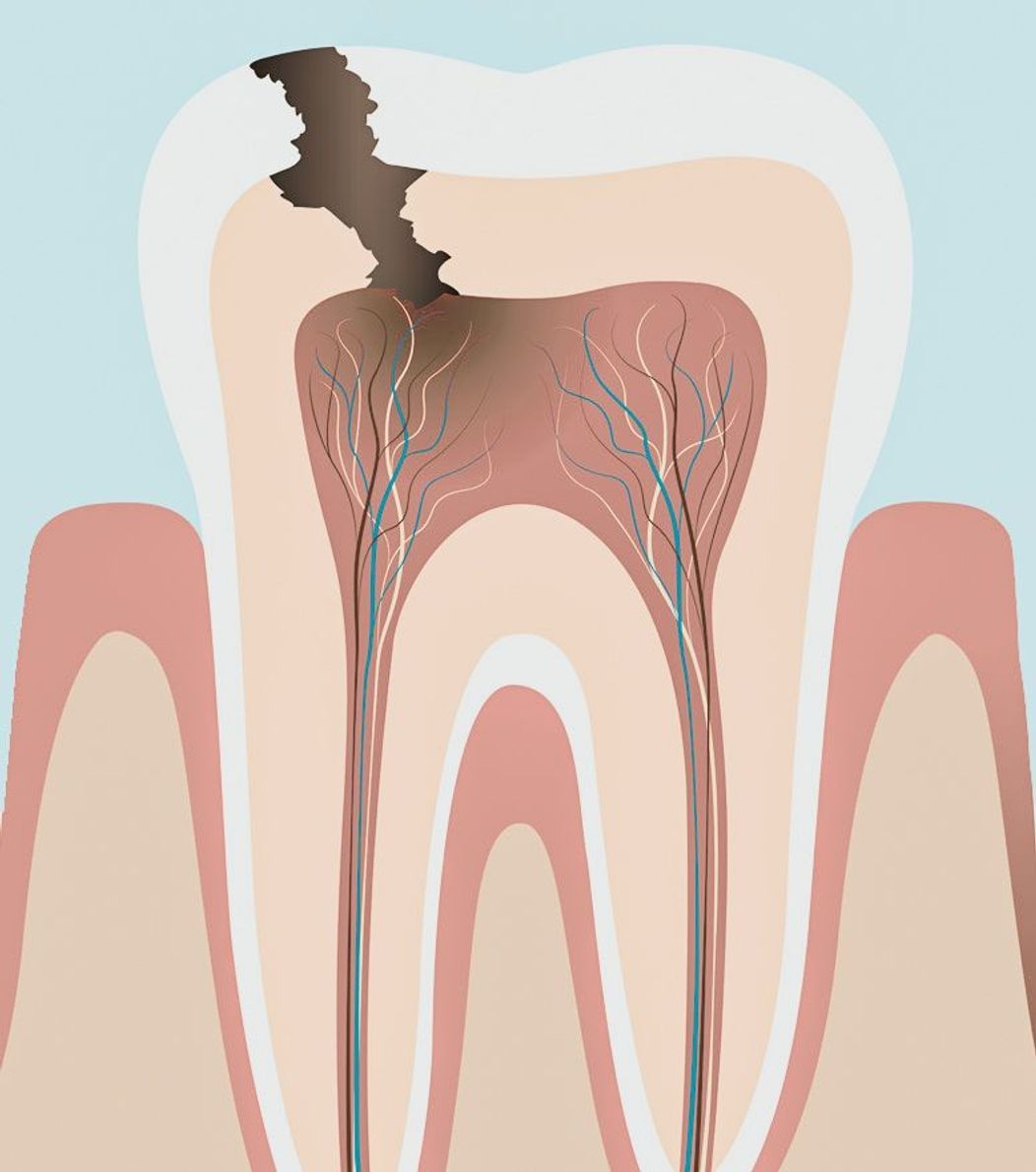 An image of the anatomy of a tooth showing progressing dental decay