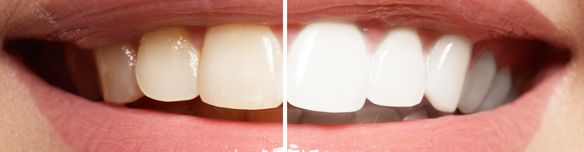 Before and after of teeth whitening on a smile.