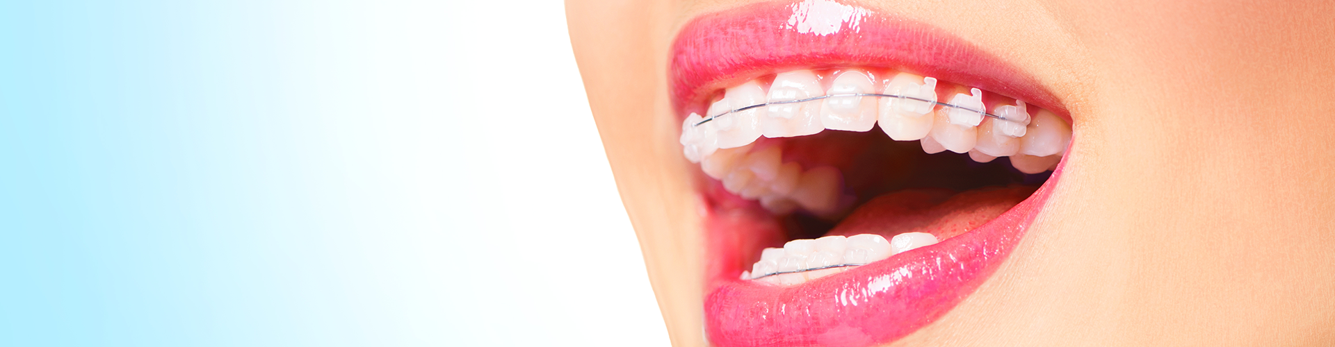 Close up of a woman's smile with braces.