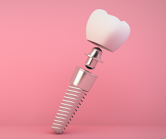 3D render dental implant