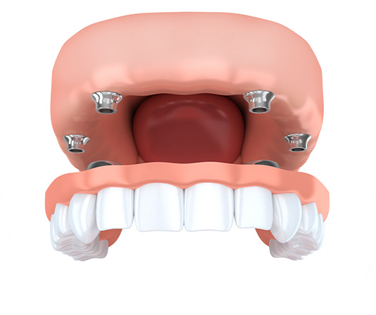 3D render of dental all on 4